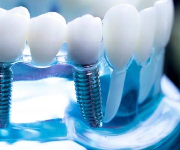 Innovations in Dental Implant Technology: What’s New?